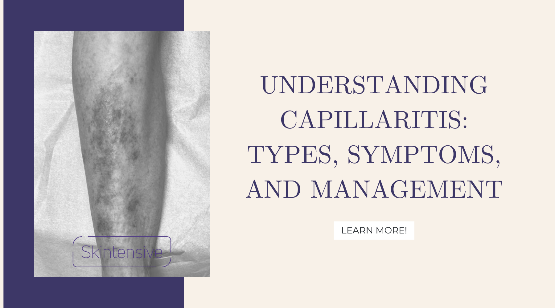 Understanding Capillaritis: Types, Symptoms, and Management